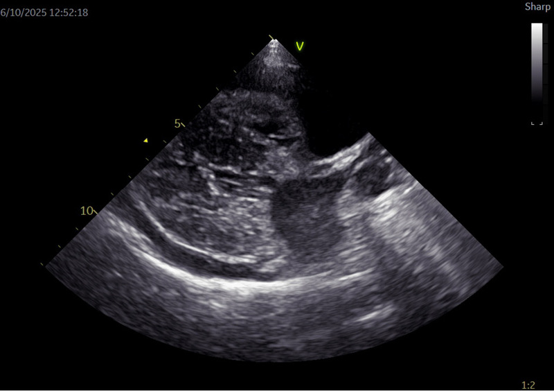Medium tamponada ryc4 fmt