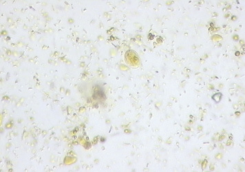 giardia spp u psa confluent and reticulated papillomatosis medscape